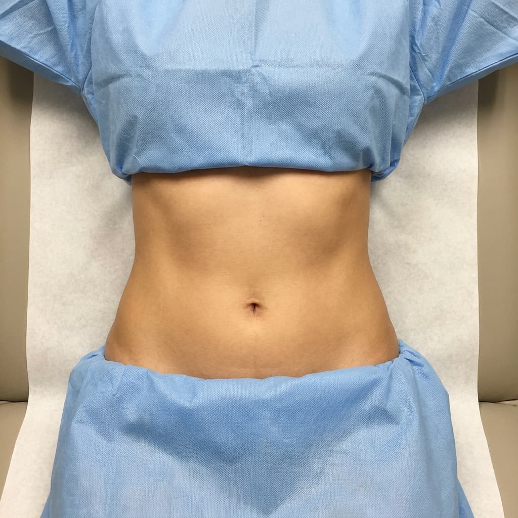 After Contorno Corporal